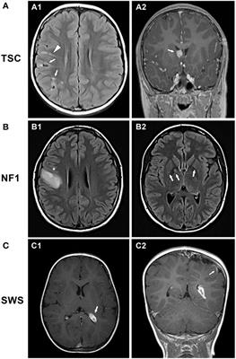 Epilepsy Mechanisms in Neurocutaneous Disorders: Tuberous Sclerosis Complex, Neurofibromatosis Type 1, and Sturge–Weber Syndrome